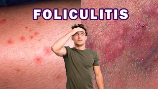 CÓMO ELIMINAR LA FOLICULITIS INFECCIOSA  BACTERIANA [upl. by Selwyn107]