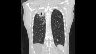 Chronic pulmonary aspergillosis after pulmonary tuberculosis [upl. by Airdni942]