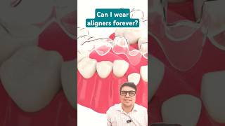 Can I wear Aligners forever [upl. by Abram]