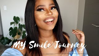 My Smile Journey Retainers Journey South African YouTuber [upl. by Annauqal]