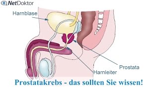 Prostatakrebs – das sollten Sie wissen  NetDoktorde [upl. by Assanav]