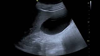 pleural effusion in CKD patient [upl. by Nesaj]