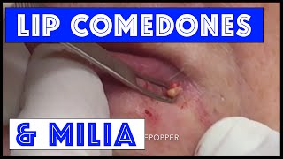 Milia around the mouth that were stubborn [upl. by Win]