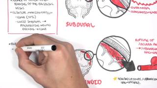 Intracranial Haemorrhage Types signs and symptoms [upl. by Meggi]