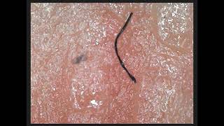 Skin Desease  What It Is  Morgellons Desease  The silent pandemic Aspergillus Fumigatus [upl. by Buehrer]