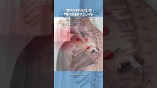 Are Infraspinatus Trigger Points Causing Your Shoulder Pain [upl. by Edgardo333]