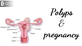 Do polyps stop you getting pregnant amp its management  Dr Rashmi Yogish [upl. by Alten367]