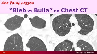 Pulmonary Blebs vs Bullae [upl. by Marika]