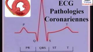 Interprétation de LÉlectrocardiogramme ischémie et infarctus du myocarde [upl. by Freberg]