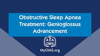 Obstructive Sleep Apnea Treatment Genioglossus Advancement [upl. by Nnewg]