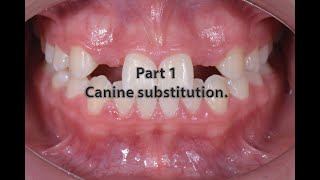 Management of missed lateral  canine substitution [upl. by Annawt]