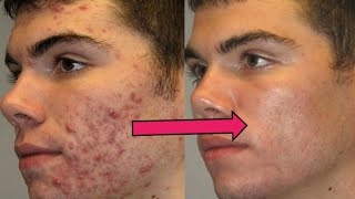 Acnestar Cream  Acne Removal  Pimples removal [upl. by Gerc]