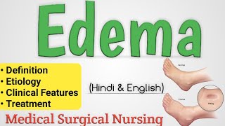 Edema  Edema In Hindi  Oedema [upl. by Nnyladnarb]