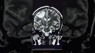 Wallerian degeneration of Corticospinal tract [upl. by Leumhs]