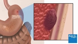 How a peptic ulcer develops  Bupa Health [upl. by Nevla]