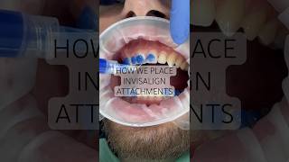 How we place Invisalign attachments or ‘buttons’… 🙌 invisalign newsmile viral [upl. by Graeme]