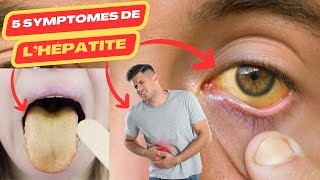 5 symptômes de lhépatite  hépatite virale c  hépatite virale b  hepatite a  hépatite [upl. by Adnawal]