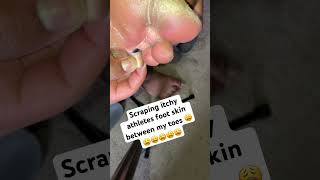 Scratching itchy athletes foot skin between toes 😫😫 satisfying deadskin pedicure tineapedis [upl. by Pizor355]