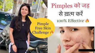 How To Remove Pimples  Pimples Treatment At Home  Spotless Glowing Skin  Dr Upasana Vohra [upl. by Madella157]