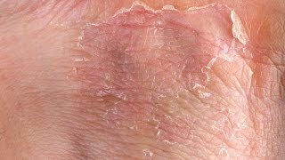 Eczema GRAPHIC Fast Outbreak Treatment Options  Eczema Dermatitis Rash Treatment 2015 [upl. by Vasiliki]