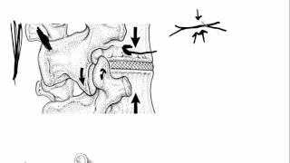 Why Facet Joint Pain Hurts So Bad [upl. by Bridgid415]