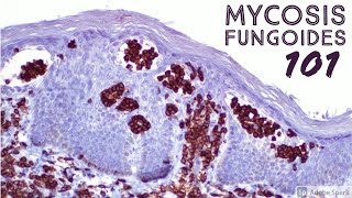 Mycosis Fungoides 101 Cutaneous Tcell Lymphoma CTCL for Dermatopathology Pathology Dermatology [upl. by Giamo827]