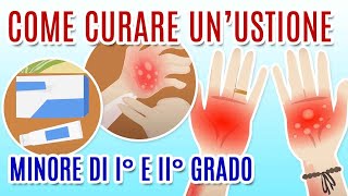 COME CURARE LE USTIONI [upl. by Gwendolin]