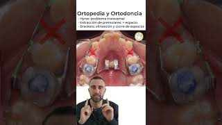 Ortodoncia y Ortopedia 👉🏼 Hyrax 💀↔️🦷 Brackets [upl. by Oos]