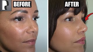 Ethnic Rhinoplasty amp Lip Lift Review amp Testimonial [upl. by Elleron680]