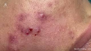 Big Cystic Acne Blackheads Extraction Blackheads amp Milia Whiteheads Removal Pimple Popping [upl. by Welch4]