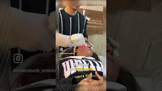 Acne Scar Treatment  Dr Ankur Sarin [upl. by Sucramad767]