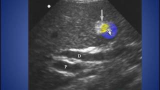 radiology cases echogenic falciform ligament [upl. by Arrahs]