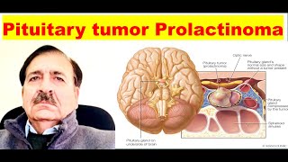 Prolactinoma Signs Symptoms diagnosis and Treatment Lectures by Dr Alamzeb [upl. by Ayekram691]