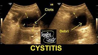 Cystitis  Ultrasound  Case 29 [upl. by Hartnett307]