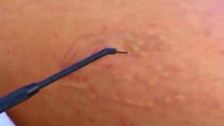 MEK3 Einweisungsvideo 1 Lifting Tattoo Epilation Haare Falten [upl. by Philender]