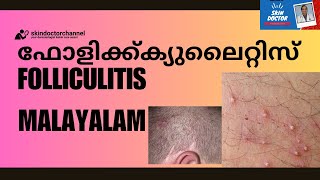 Folliculitis Malayalam sycosis barbaebarbers itchscalp folliculitis malayalam dr sujith karimbil [upl. by Annayram]