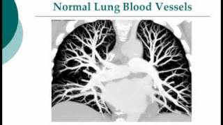 Your Radiologist Explains Computed Tomography CT Pulmonary Embolism [upl. by Edla]