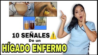 10 SEÑALES que Indican que tú HÍGADO está ENFERMO😨 Que te Sorprenderán  Signos y Síntomas [upl. by Leihcim986]