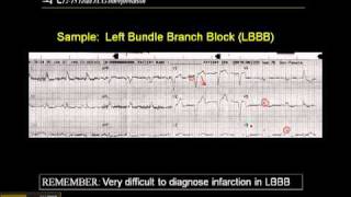 1215 Lead ECG Left Bundle Branch Block [upl. by Yerag]