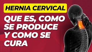 HERNIA CERVICAL C5C6 SINTOMAS TRATAMIENTO Y EJERCICIO ✅ [upl. by Ahsier]