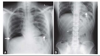 Perforated Viscus Part 2 [upl. by Nagam]