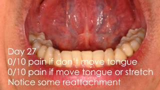 Laser Tongue Tie Revision Healing and Care Instructions [upl. by Sucramad849]