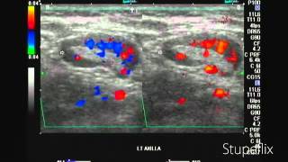 Left axillary lymph node enlargement in breast cancer [upl. by Ledarf]