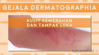 Dermatographia [upl. by Anniram524]