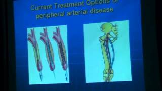 Endovascular Management of Ischaemic Diabetic Foot [upl. by Eskill]