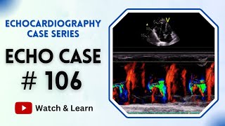 ECHO Case 106  Echocardiography for Beginners echocardiogram [upl. by Martsen]