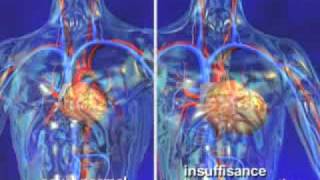 Insuffisance cardiaque dépistage de l’insuffisance cardiaque en vidéo santé 3D [upl. by Gredel]