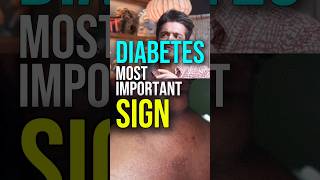 Dark Patches on Skin Discover the Hidden Sign of Diabetes – Acanthosis Nigricans shorts ytshorts [upl. by Meredi637]