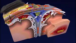 brain hemorrhage  stroke haemorrhage I extracranial hemorrhage  intracranial hemorrhage types I [upl. by Alorac61]