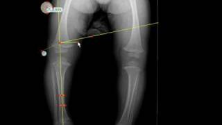 TraumaCad  MetaphysealDiaphyseal Angle [upl. by Hael]